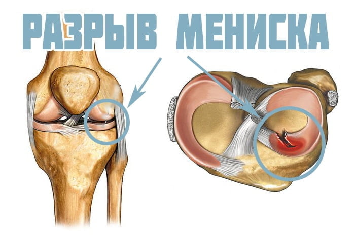 Результат по лечению травма колена с разрывом менисков