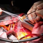 Избежал операци на сердечный клапан