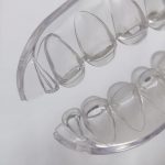 Элайнеры как альтернатива брекетам: сравниваем плюсы и минусы